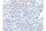 The image on the left is immunohistochemistry of paraffin-embedded Human lung cancer tissue using CSB-PA697138(ADAM7 Antibody) at dilution 1/30, on the right is treated with fusion protein. (Original magnification: 