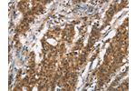 The image on the left is immunohistochemistry of paraffin-embedded Human gastic cancer tissue using CSB-PA697671(BCAS4 Antibody) at dilution 1/50, on the right is treated with synthetic peptide. (Original magnification: 
