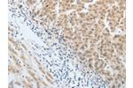 The image on the left is immunohistochemistry of paraffin-embedded Human liver cancer tissue using CSB-PA697958(AKAP8L Antibody) at dilution 1/20, on the right is treated with synthetic peptide. (Original magnification: 