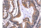 The image on the left is immunohistochemistry of paraffin-embedded Human colon cancer tissue using CSB-PA698018(ARC Antibody) at dilution 1/50, on the right is treated with fusion protein. (Original magnification: 