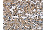The image on the left is immunohistochemistry of paraffin-embedded Human thyroid cancer tissue using CSB-PA698112(BMPR1B Antibody) at dilution 1/25, on the right is treated with fusion protein. (Original magnification: 