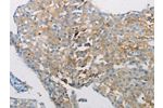 The image on the left is immunohistochemistry of paraffin-embedded Human breast cancer tissue using CSB-PA698191(AATK Antibody) at dilution 1/10, on the right is treated with synthetic peptide. (Original magnification: 