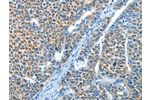 The image on the left is immunohistochemistry of paraffin-embedded Human liver cancer tissue using CSB-PA698673(ADRA1B Antibody) at dilution 1/25, on the right is treated with synthetic peptide. (Original magnification: 