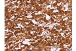 The image on the left is immunohistochemistry of paraffin-embedded Human thyroid cancer tissue using CSB-PA698728(ARPC4 Antibody) at dilution 1/15, on the right is treated with synthetic peptide. (Original magnification: 