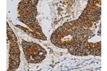The image on the left is immunohistochemistry of paraffin-embedded Human colon cancer tissue using CSB-PA698741(CCNF Antibody) at dilution 1/20, on the right is treated with fusion protein. (Original magnification: 