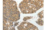 The image on the left is immunohistochemistry of paraffin-embedded Human liver cancer tissue using CSB-PA699224(GRK4 Antibody) at dilution 1/40, on the right is treated with fusion protein. (Original magnification: 