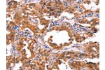 The image on the left is immunohistochemistry of paraffin-embedded Human thyroid cancer tissue using CSB-PA699373(ERAS Antibody) at dilution 1/40, on the right is treated with synthetic peptide. (Original magnification: 