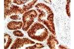 Immunohistochemical analysis of paraffin-embedded Human Colon Carcinoma Tissue using HSP40 Rabbit  pAb diluted at 1:200