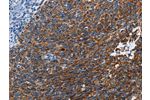 The image on the left is immunohistochemistry of paraffin-embedded Human cervical cancer tissue using CSB-PA703411(ETHE1 Antibody) at dilution 1/20, on the right is treated with fusion protein. (Original magnification: 