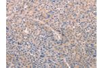 The image on the left is immunohistochemistry of paraffin-embedded Human liver cancer tissue using CSB-PA703896(A4GNT Antibody) at dilution 1/25, on the right is treated with fusion protein. (Original magnification: 