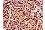 Immunohistochemistry of paraffin-embedded human ovarian cancer using CSB-PA705509LA01HU at dilution of 1:100