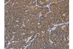 The image on the left is immunohistochemistry of paraffin-embedded Human ovarian cancer tissue using CSB-PA706521(FABP6 Antibody) at dilution 1/30, on the right is treated with fusion protein. (Original magnification: 