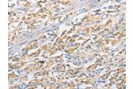 The image on the left is immunohistochemistry of paraffin-embedded Human thyroid cancer tissue using CSB-PA706929(APPBP2 Antibody) at dilution 1/25, on the right is treated with fusion protein. (Original magnification: 