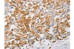 The image on the left is immunohistochemistry of paraffin-embedded Human thyroid cancer tissue using CSB-PA707391(ARMCX3 Antibody) at dilution 1/40, on the right is treated with fusion protein. (Original magnification: 