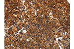 The image on the left is immunohistochemistry of paraffin-embedded Human breast cancer tissue using CSB-PA708217(CMTM3 Antibody) at dilution 1/10, on the right is treated with synthetic peptide. (Original magnification: 