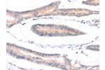 The image on the left is immunohistochemistry of paraffin-embedded Human colon cancer tissue using CSB-PA708534(ADAP1 Antibody) at dilution 1/40, on the right is treated with fusion protein. (Original magnification: 