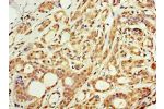 Immunohistochemistry of paraffin-embedded human breast cancer using CSB-PA709601ESR1HU at dilution 1:100