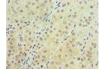 Immunohistochemistry of paraffin-embedded human liver cancer using CSB-PA711453ESR2HU at dilution 1:100