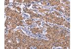 The image on the left is immunohistochemistry of paraffin-embedded Human gastic cancer tissue using CSB-PA715796(EP300 Antibody) at dilution 1/20, on the right is treated with synthetic peptide. (Original magnification: 