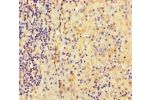Immunohistochemistry of paraffin-embedded human lung cancer using CSB-PA716349LA01HU at dilution of 1:100