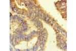 Immunohistochemistry of paraffin-embedded human endometrial cancer using CSB-PA718074LA01HU at dilution of 1:100