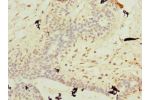 Immunohistochemistry of paraffin-embedded human breast cancer using CSB-PA719409LA01HU at dilution of 1:100
