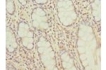Immunohistochemistry of paraffin-embedded human colon cancer using CSB-PA719420DSR2HU at dilution 1:100