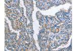 The image on the left is immunohistochemistry of paraffin-embedded Human thyroid cancer tissue using CSB-PA719443(AP2S1 Antibody) at dilution 1/25, on the right is treated with fusion protein. (Original magnification: 