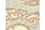 Immunohistochemistry of paraffin-embedded human colon cancer using CSB-PA719622LA01HU at dilution of 1:100