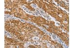 The image on the left is immunohistochemistry of paraffin-embedded Human gastic cancer tissue using CSB-PA722114(CENPE Antibody) at dilution 1/50, on the right is treated with synthetic peptide. (Original magnification: 
