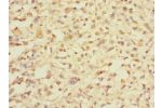Immunohistochemistry of paraffin-embedded human melanoma CSB-PA722563LA01HU at dilution 1:100