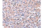 The image on the left is immunohistochemistry of paraffin-embedded Human thyroid cancer tissue using CSB-PA722618(FEM1B Antibody) at dilution 1/20, on the right is treated with synthetic peptide. (Original magnification: 