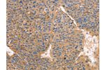 The image on the left is immunohistochemistry of paraffin-embedded Human liver cancer tissue using CSB-PA725644(GNB1 Antibody) at dilution 1/25, on the right is treated with fusion protein. (Original magnification: 