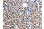 The image on the left is immunohistochemistry of paraffin-embedded Human thyroid cancer tissue using CSB-PA725690(ALG8 Antibody) at dilution 1/30, on the right is treated with fusion protein. (Original magnification: 