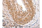 The image on the left is immunohistochemistry of paraffin-embedded Human cervical cancer tissue using CSB-PA725796(ART4 Antibody) at dilution 1/30, on the right is treated with synthetic peptide. (Original magnification: 
