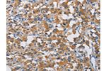 The image on the left is immunohistochemistry of paraffin-embedded Human thyroid cancer tissue using CSB-PA725805(CRTAM Antibody) at dilution 1/30, on the right is treated with fusion protein. (Original magnification: 
