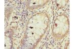 Immunohistochemistry of paraffin-embedded human colon cancer using CSB-PA726395LA01HU at dilution of 1:100