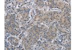 The image on the left is immunohistochemistry of paraffin-embedded Human gastric cancer tissue using CSB-PA727123(DNAJB4 Antibody) at dilution 1/50, on the right is treated with fusion protein. (Original magnification: 