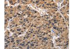The image on the left is immunohistochemistry of paraffin-embedded Human liver cancer tissue using CSB-PA729627(ABI3BP Antibody) at dilution 1/50, on the right is treated with fusion protein. (Original magnification: 