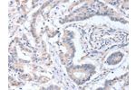 The image on the left is immunohistochemistry of paraffin-embedded Human colon cancer tissue using CSB-PA729731(ACOT9 Antibody) at dilution 1/15, on the right is treated with fusion protein. (Original magnification: 