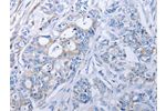 The image on the left is immunohistochemistry of paraffin-embedded Human colon cancer tissue using CSB-PA729886(ALDH1A1/ALDH1A2/ALDH1A3 Antibody) at dilution 1/40, on the right is treated with fusion protein. (Original magnification: 
