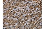 The image on the left is immunohistochemistry of paraffin-embedded Human breast cancer tissue using CSB-PA729928(FTO Antibody) at dilution 1/60, on the right is treated with fusion protein. (Original magnification: 