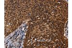 The image on the left is immunohistochemistry of paraffin-embedded Human cervical cancer tissue using CSB-PA730045(FASTKD5 Antibody) at dilution 1/40, on the right is treated with fusion protein. (Original magnification: 