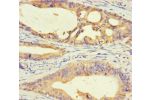Immunohistochemistry of paraffin-embedded human colon cancer using CSB-PA730143LA01HU at dilution of 1:100