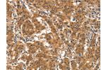 The image on the left is immunohistochemistry of paraffin-embedded Human gastic cancer tissue using CSB-PA731077(EID3 Antibody) at dilution 1/15, on the right is treated with synthetic peptide. (Original magnification: 