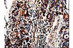 The image on the left is immunohistochemistry of paraffin-embedded Human stomach cancer tissue using CSB-PA732422(ACSBG2 Antibody) at dilution 1/60, on the right is treated with fusion protein. (Original magnification: 