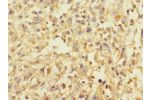 Immunohistochemistry of paraffin-embedded human melanoma CSB-PA732925LA01HU at dilution 1:100