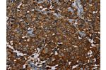 The image on the left is immunohistochemistry of paraffin-embedded Human breast cancer tissue using CSB-PA736786(ERBB4 Antibody) at dilution 1/40, on the right is treated with fusion protein. (Original magnification: 