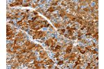 The image on the left is immunohistochemistry of paraffin-embedded Human liver cancer tissue using CSB-PA736913(ALDOB Antibody) at dilution 1/55, on the right is treated with synthetic peptide. (Original magnification: 