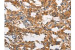 The image on the left is immunohistochemistry of paraffin-embedded Human thyroid cancer tissue using CSB-PA736949(CLTC Antibody) at dilution 1/60, on the right is treated with synthetic peptide. (Original magnification: 